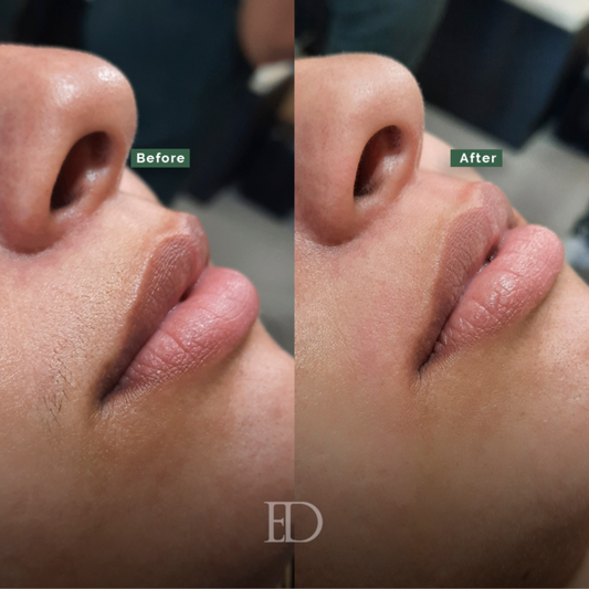 Upper Lip & Chin Epilation